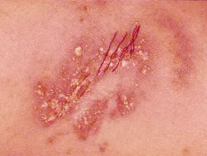 pustular psoriasis