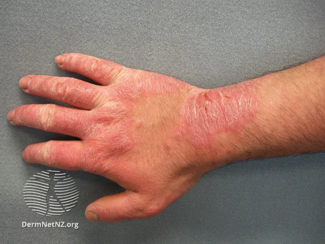 Rubber allergic contact dermatitis
