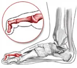 Mallet toe
