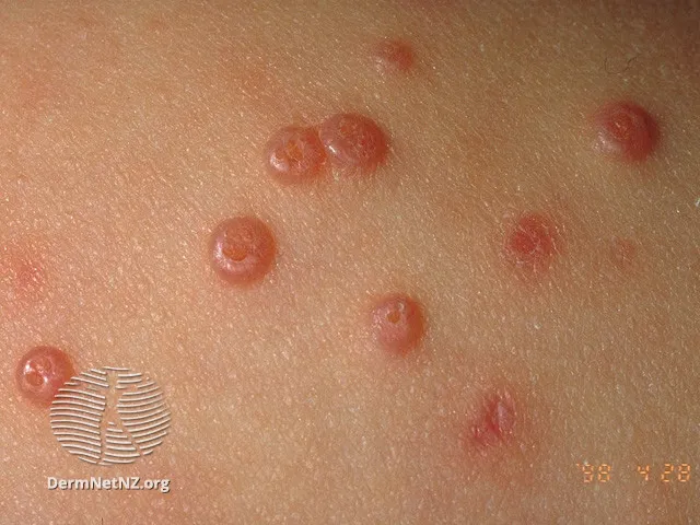 Molluscum contagiosum