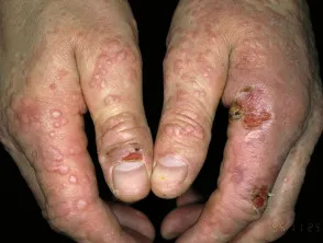 Milker's nodule