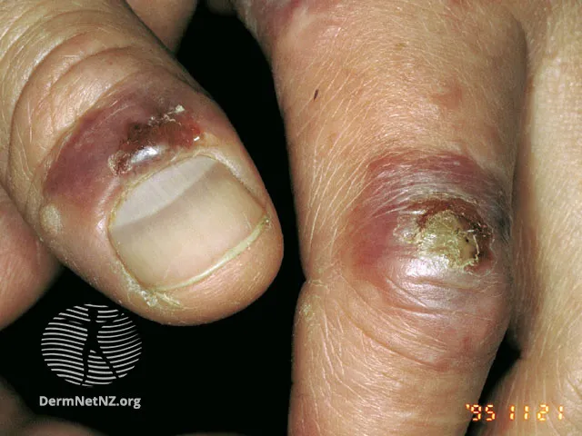 Milker's nodule