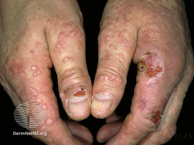 Milker's nodule
