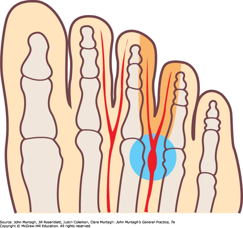 Morton neuroma — Murtagh figure 68.9