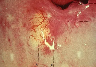Nabothian cyst