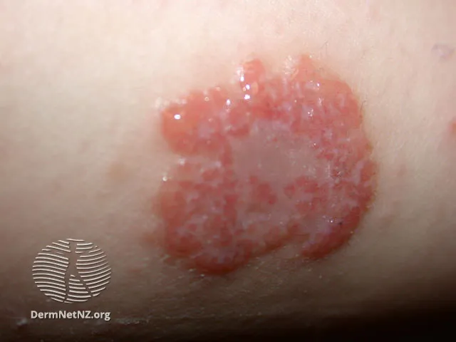 Discoid eczema