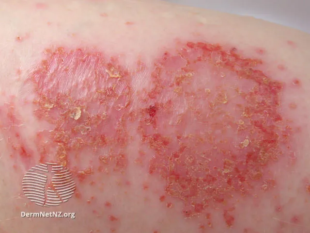 Discoid eczema