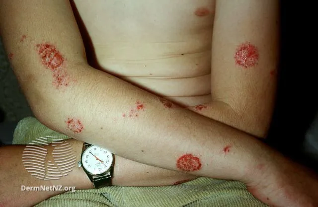 Nummular dermatitis