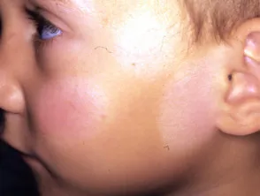 Pityriasis alba