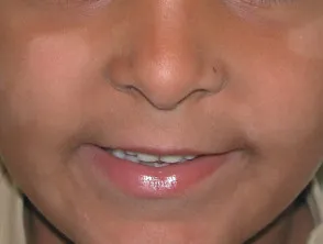 Pityriasis alba