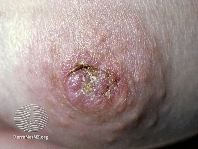 Mammary Paget disease of the nipple