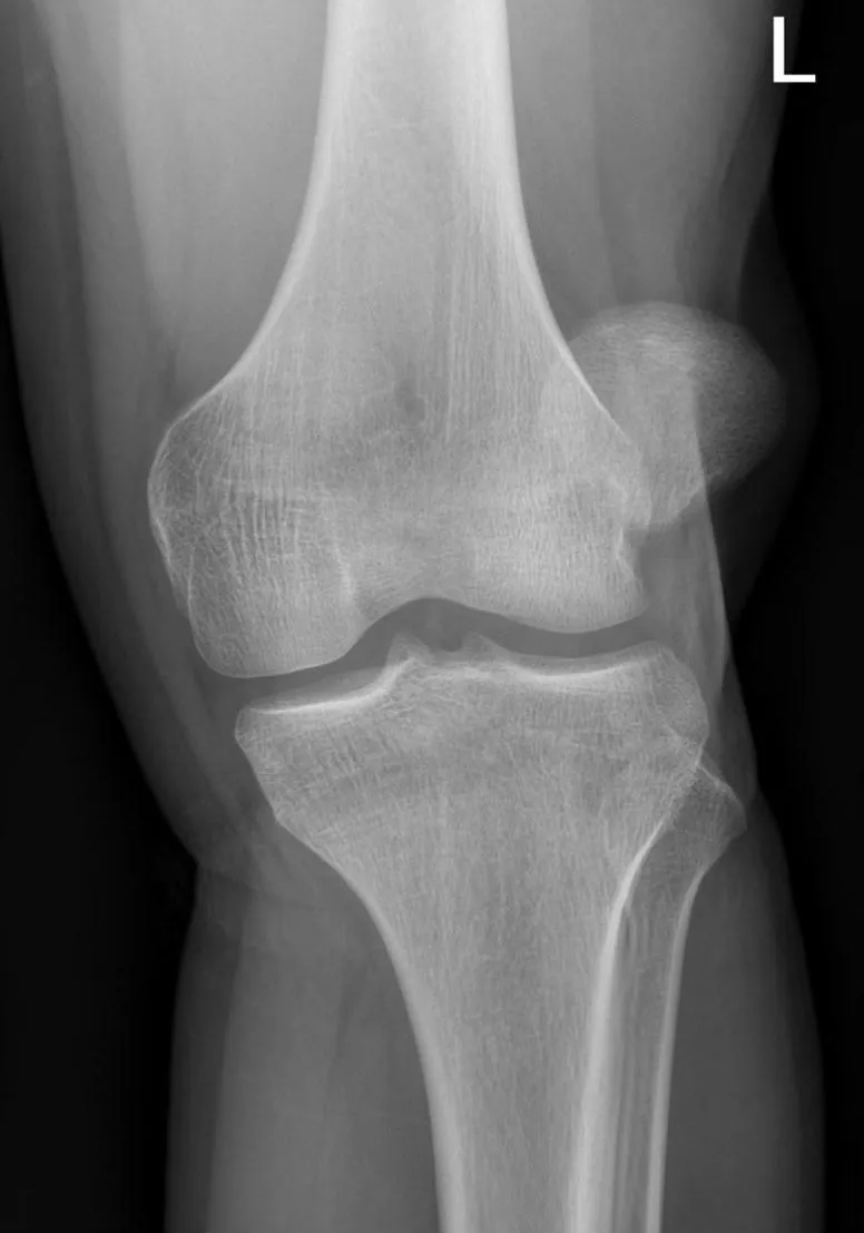Lateral patellar dislocation on AP knee X-ray — the patella lies lateral to the trochlear groove, the usual direction of displacement