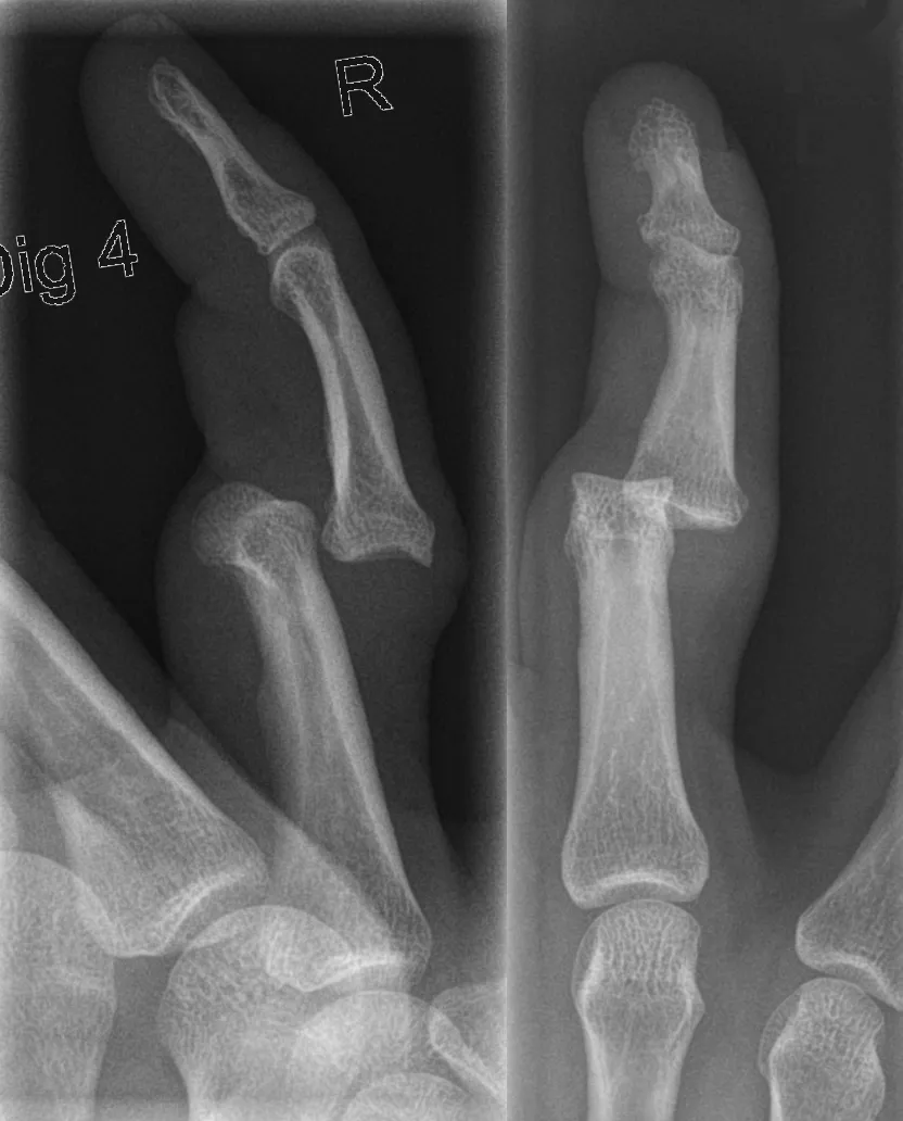 Dorsal PIP joint dislocation of the right ring finger — on the lateral view (left) the middle phalanx sits dorsal to the head of the proximal phalanx; on the AP view (right) the injury is far less obvious