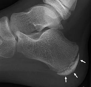 Sever disease — calcaneal apophysis