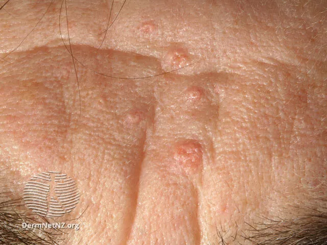 Sebaceous hyperplasia