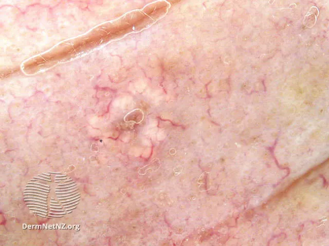 Sebaceous hyperplasia