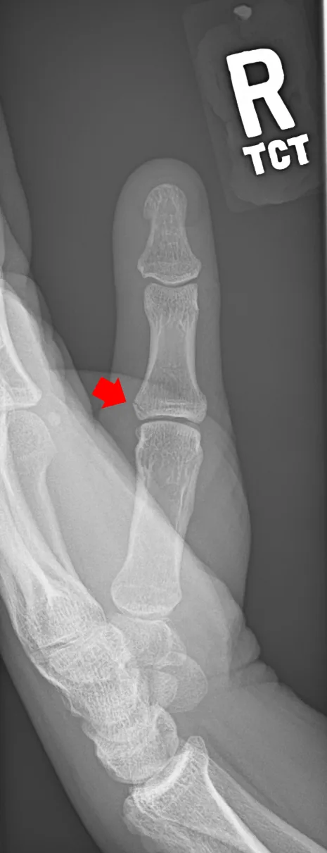 Skier's thumb — avulsion fracture at the ulnar base of the proximal phalanx of the thumb, at the ulnar collateral ligament insertion
