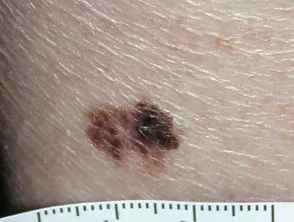 Superficial spreading melanoma