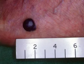 Nodular melanoma