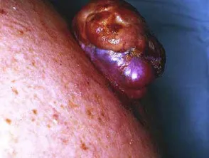 Nodular melanoma