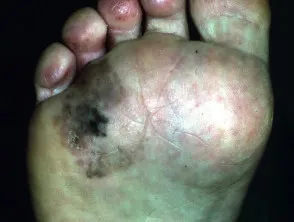 Acral lentiginous melanoma