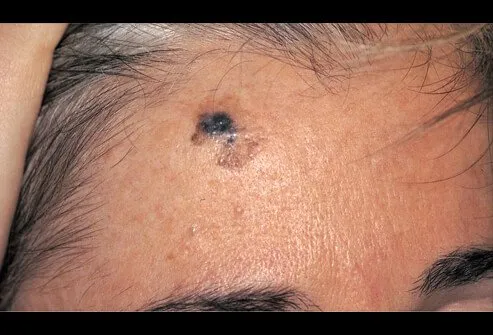 Desmoplastic melanoma