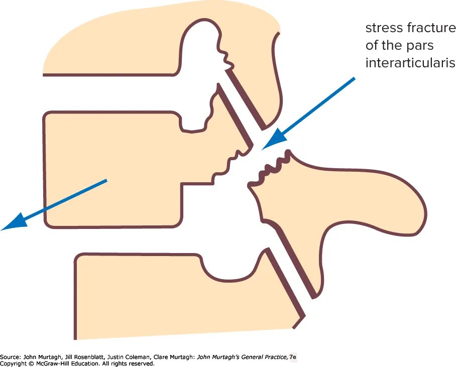 Murtagh figure 38.8 — spondylolisthesis