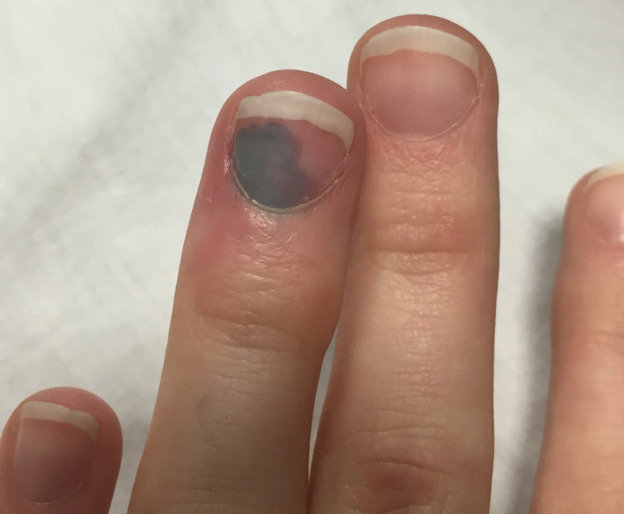 Subungual haematoma — dark blood collection visible under the nail plate after crush injury