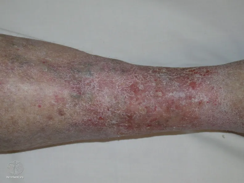 Venous eczema
