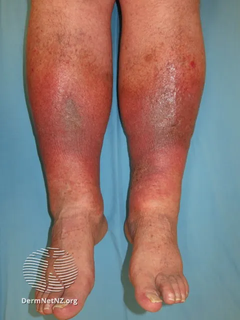 Venous eczema and lipodermatosclerosis